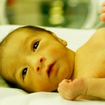 Фото: Гемолитическая желтуха у новорожденных