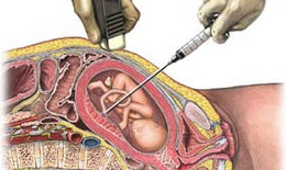 Кордоцентез при беременности