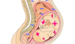 Внутриутробное переливание крови плоду при резус-конфликте