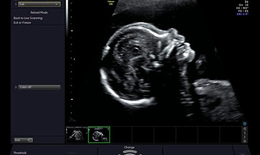 Допплерометрия при беременности